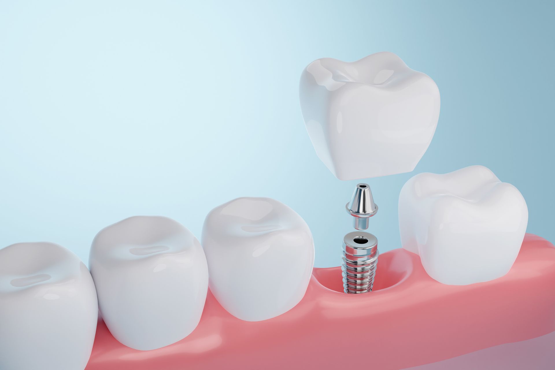 gum contouring Hamilton | tooth extraction Hamilton