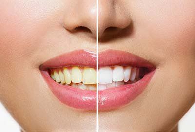 Teeth whitening before and after