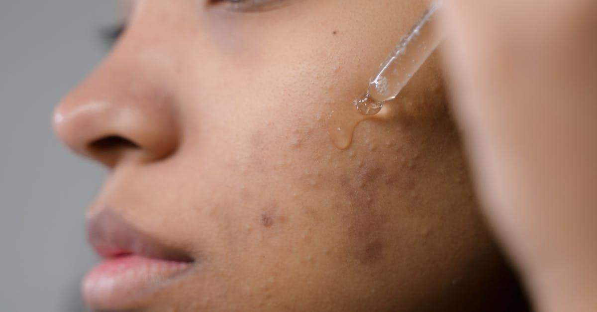 A woman is applying a serum to her face with a pipette.