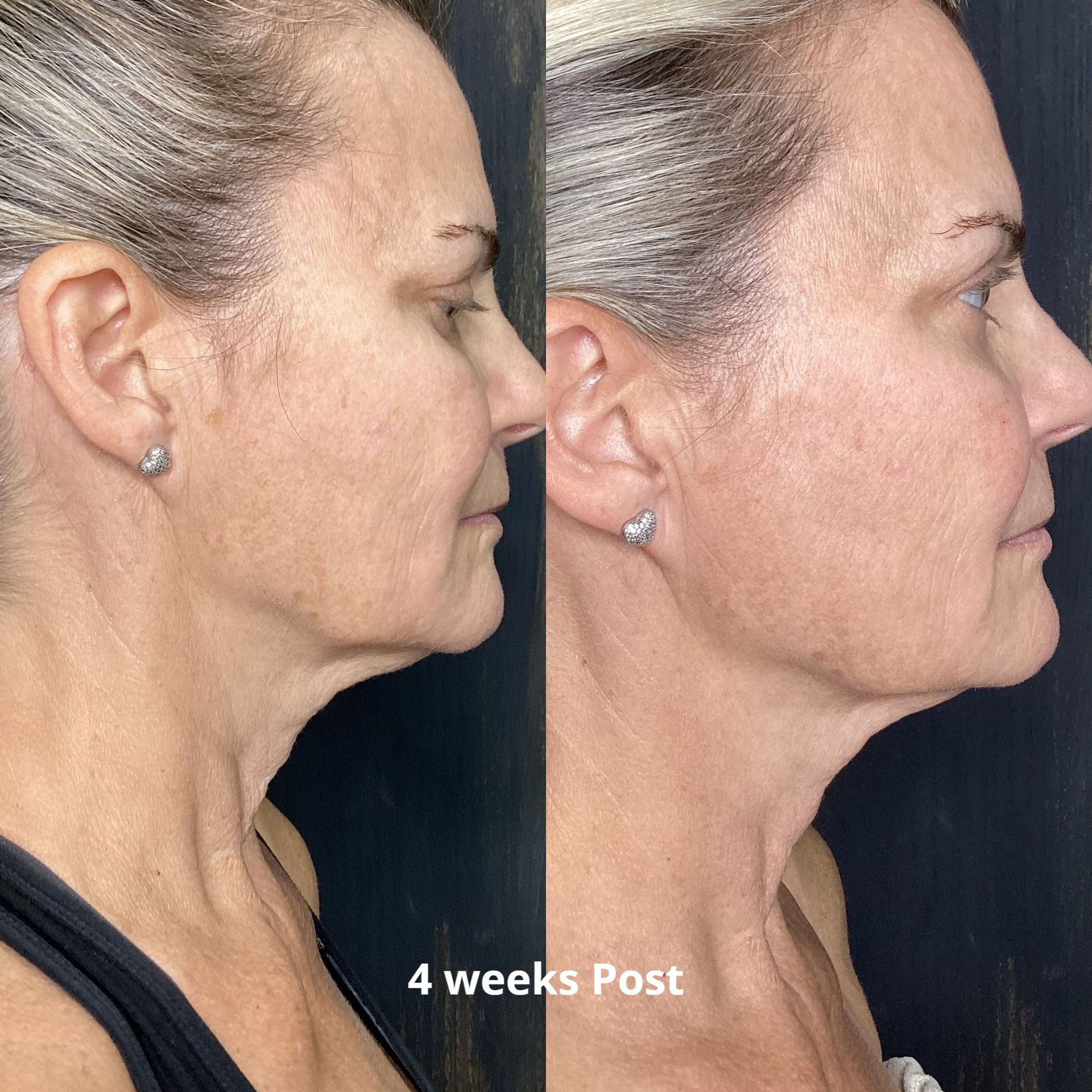 a before and after photo of a woman 's neck and face