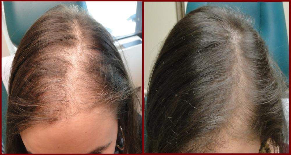PrP for Hair Restoration