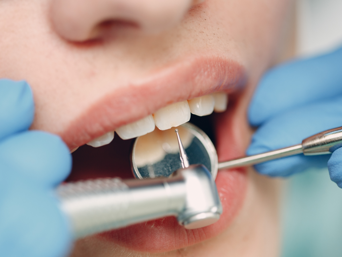 Understanding Prophylaxis Treatment: How It Protects Your Oral Health