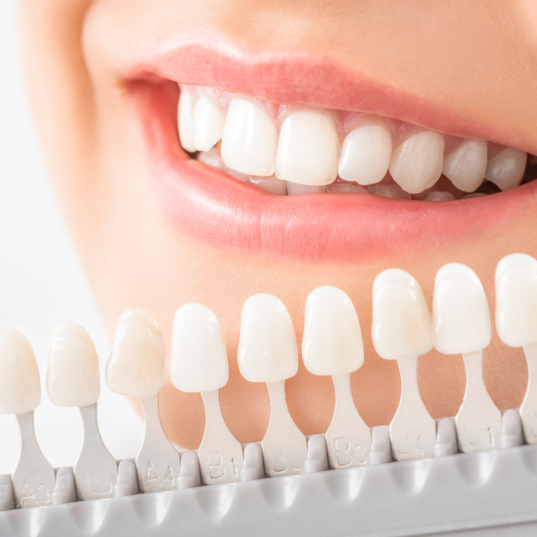 Close-up of a person smiling with bright white teeth, next to a shade guide for teeth whitening.