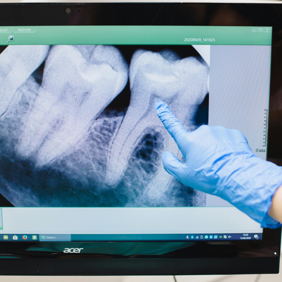 Dental X-ray on a monitor; a gloved finger points to a tooth, illustrating dental examination.