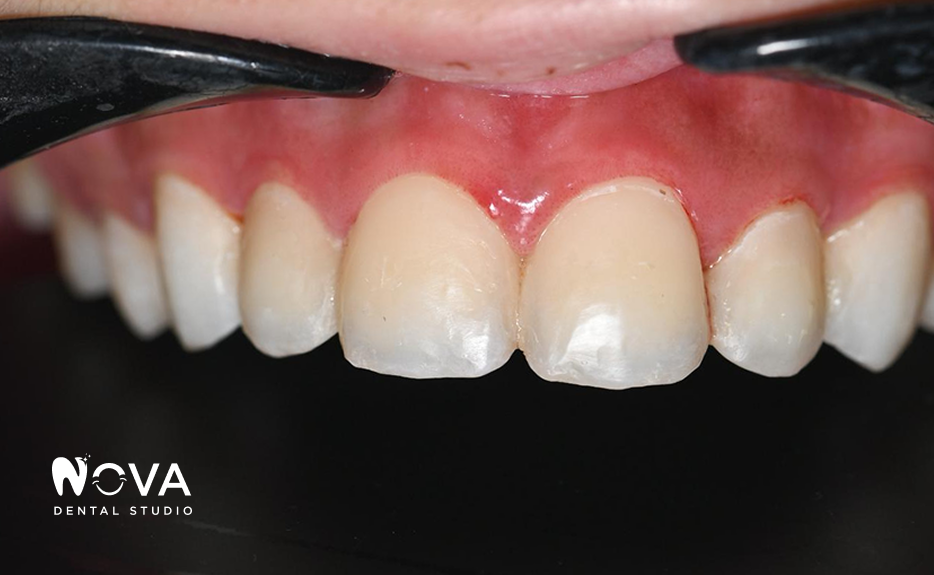 A close up of a person 's teeth with a mouth guard.