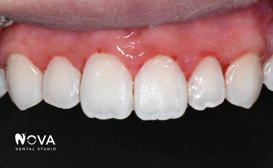 A close up of a person 's teeth with nova dental studio written on the bottom