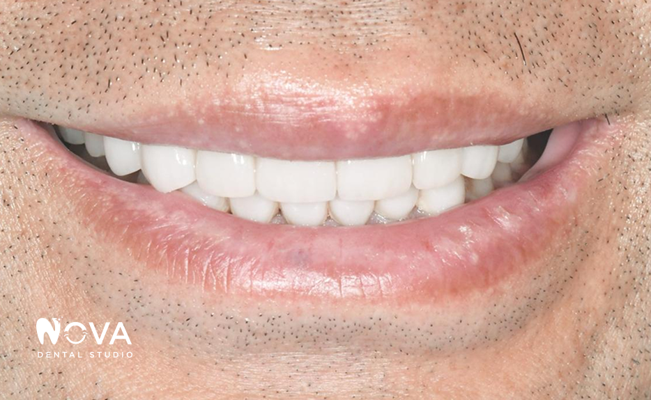 A close up of a person 's teeth from nova dental studio