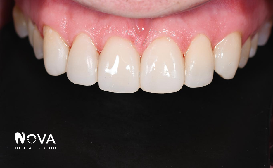 A close up of a person 's teeth with a mouth guard.