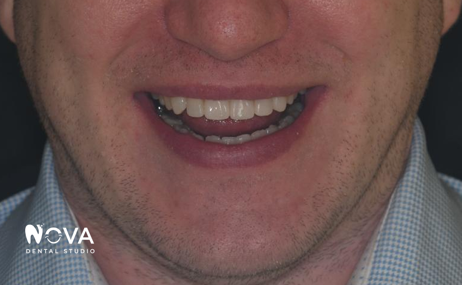 A close up of a person 's teeth from nova dental studio