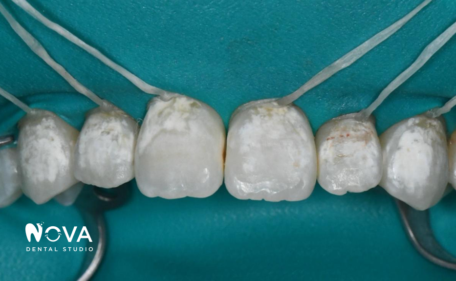 A close up of a person 's teeth with the word nova on the bottom