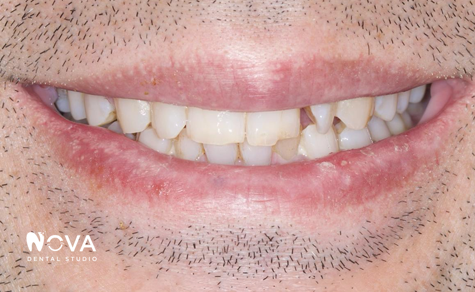 A close up of a person 's teeth and mouth.