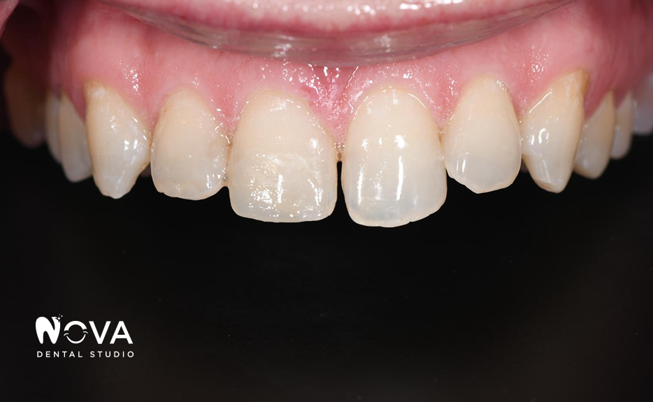 A close up of a person 's teeth and mouth.