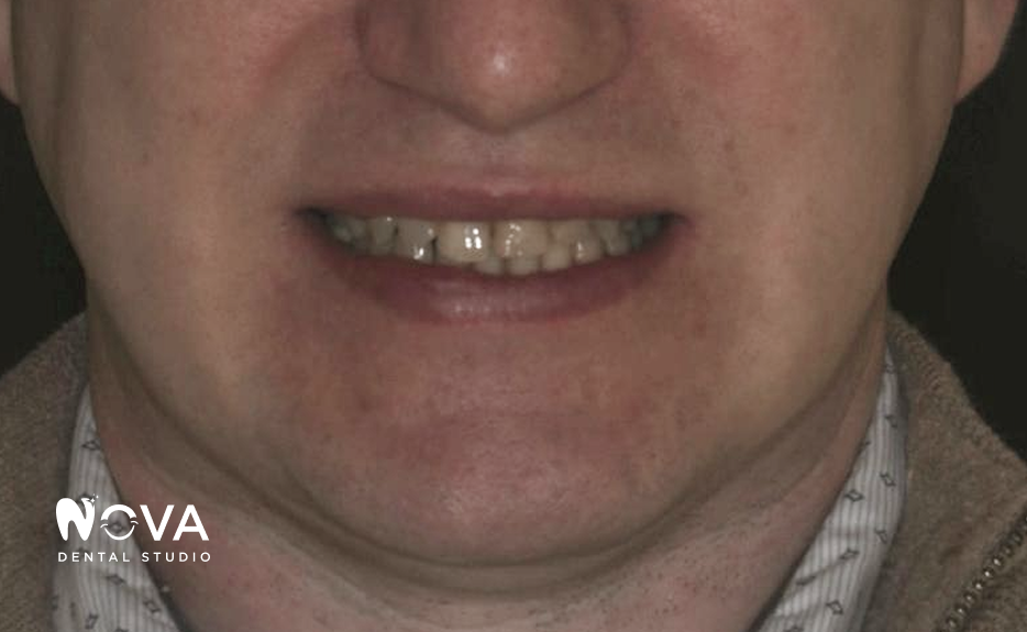 A close up of a woman 's mouth with white teeth and red lips.