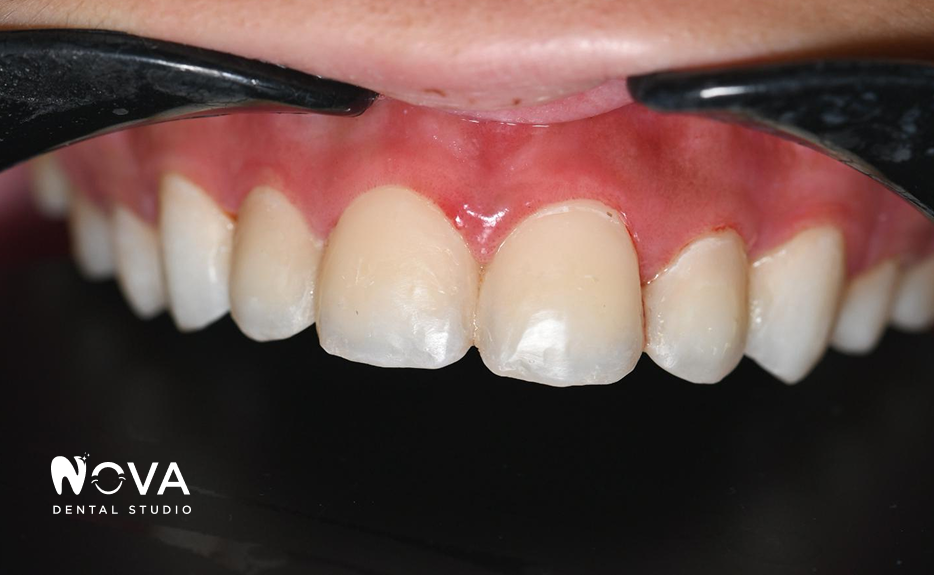 A close up of a person 's teeth with a mouth guard.