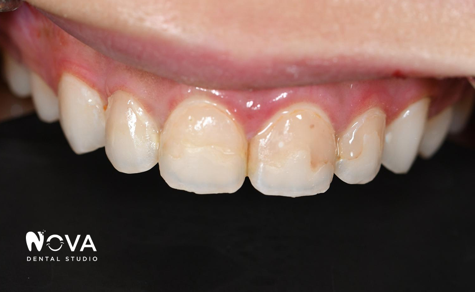 A close up of a person 's teeth and mouth.