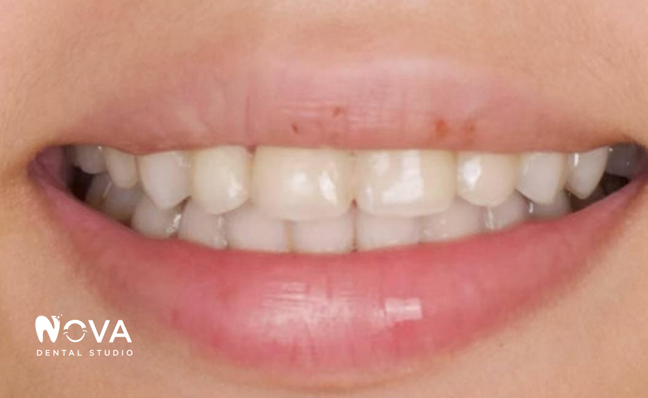 A close up of a person 's teeth from nova dental studio