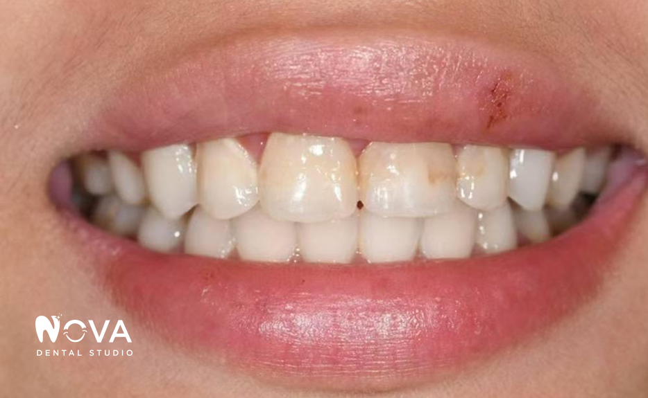 A close up of a woman 's mouth with white teeth and red lips.