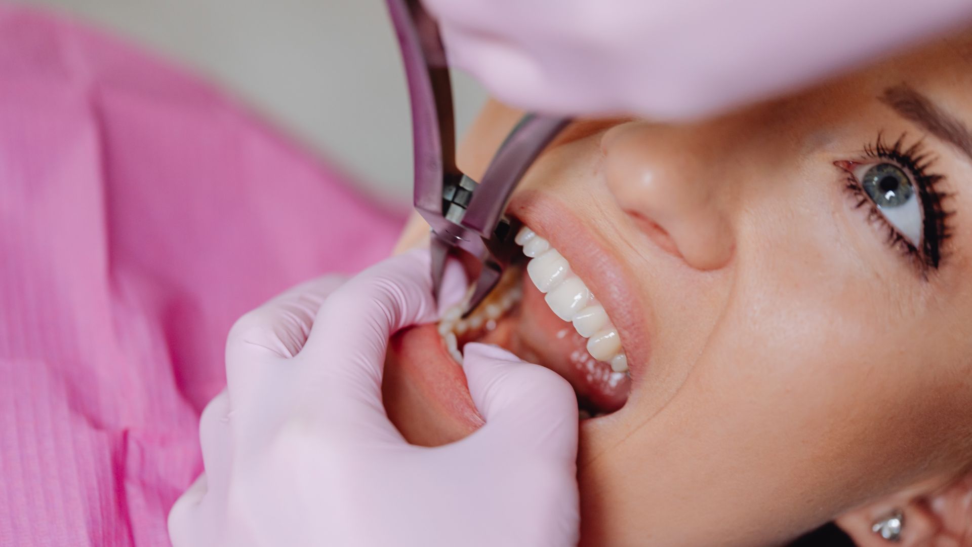Dental implant illustration: a crown being placed on an abutment attached to the implant within the jawbone.