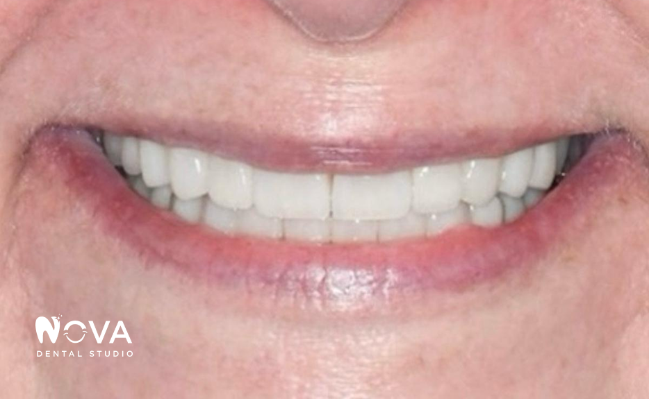 A close up of a person 's teeth with nova dental studio written on the bottom