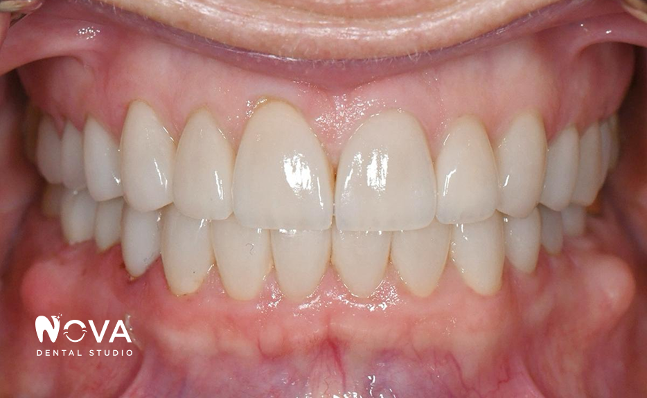 A close up of a person 's teeth with a black circle in the middle.