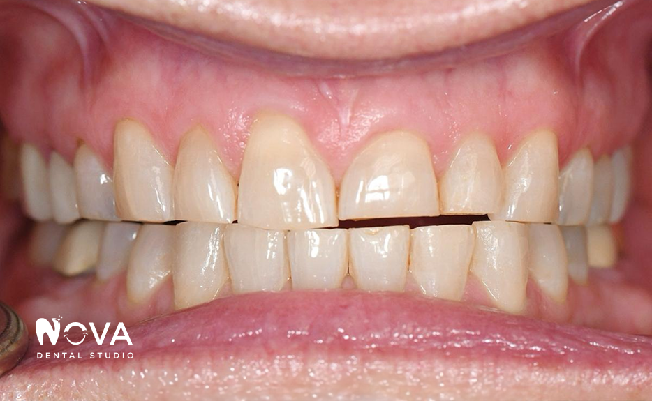 A close up of a person 's teeth with a nova dental studio logo on the bottom