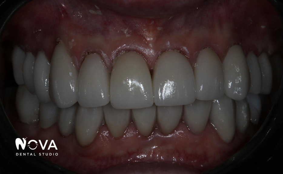 A close up of a person 's teeth from nova dental studio
