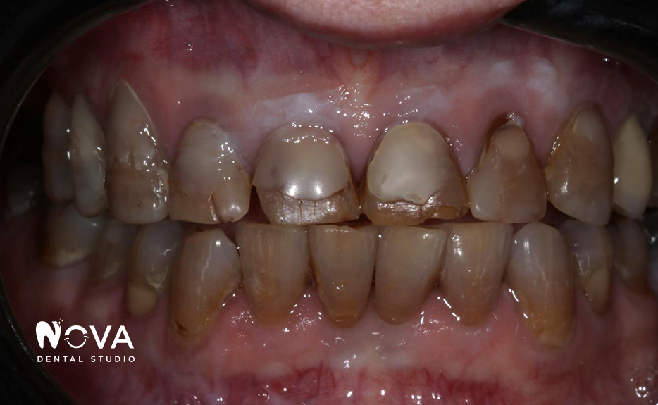 A close up of a person 's teeth with a nova dental studio logo in the corner.