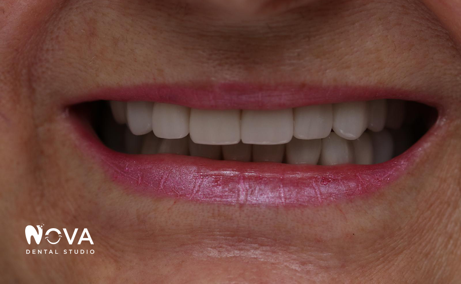 A close up of a woman 's smile with white teeth and pink lips.