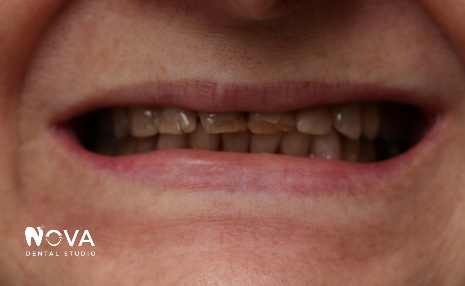 A close up of a person 's teeth with nova dental studio written on the bottom