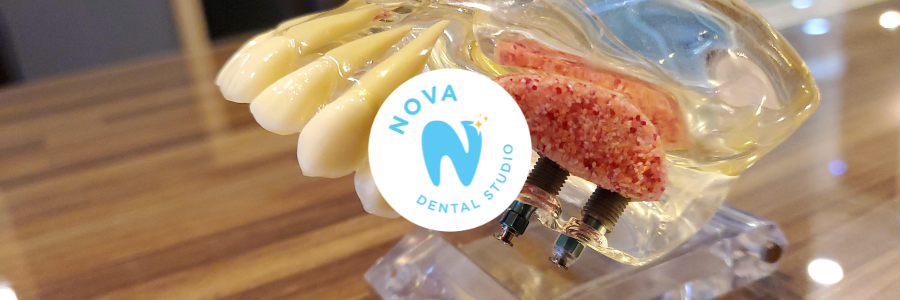 A dental model with teeth encased in plastic, featuring a Nova Dental Studio logo.