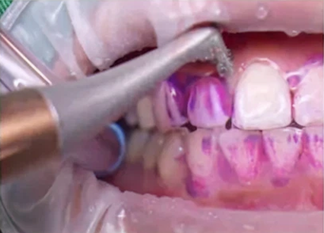 Dental hygienist cleaning teeth with rotating brush; purple stain reveals plaque.