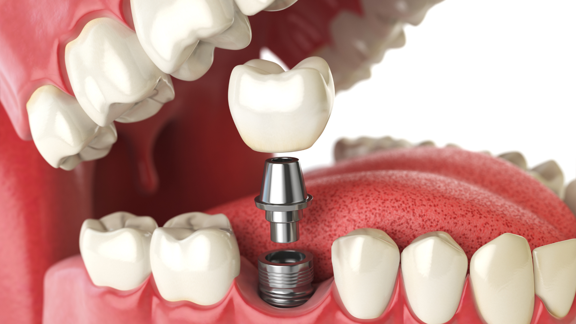 Diagram of a dental implant: crown being placed on an abutment, attached to a screw in the jaw.