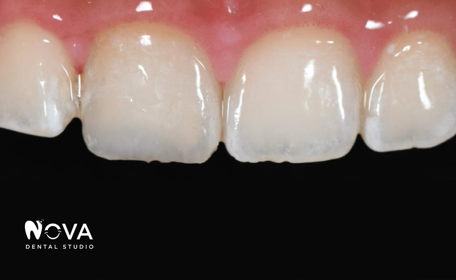 Close-up of healthy white teeth and pink gums. NOVA Dental Studio logo in the lower left corner.