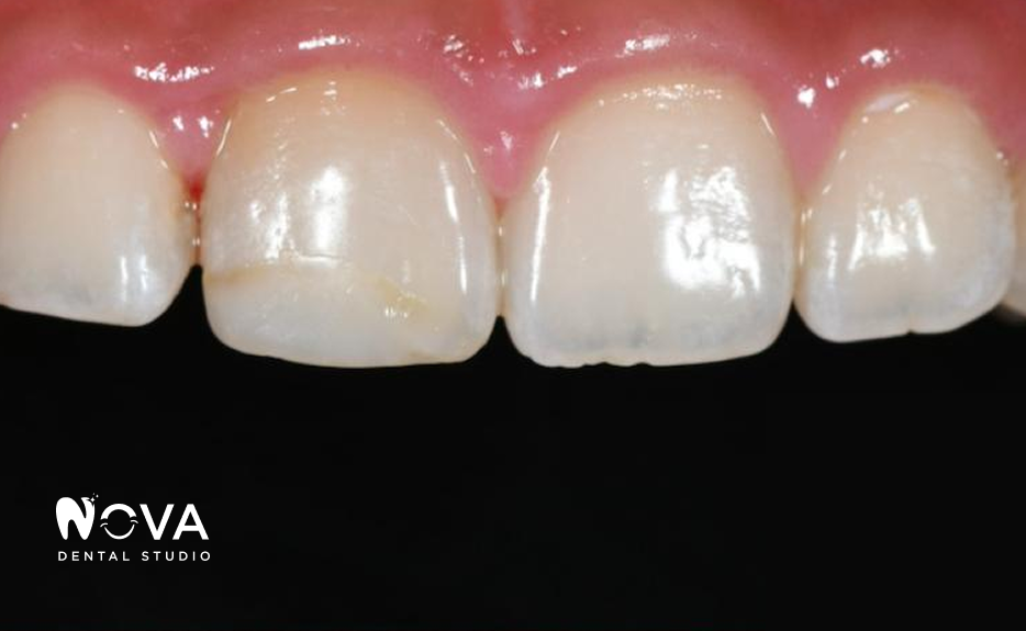 Close-up of a person's front teeth; one tooth has a cavity or repair. Pink gums against a black background.