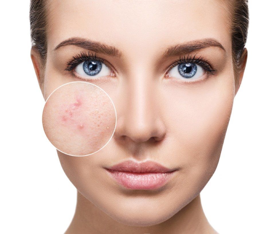 rappresentazione problemi di acne