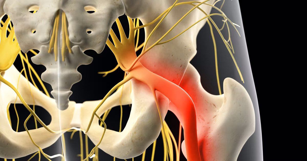 Sciatica Pain — Henderson — Advanced Spine & Rehabilitation