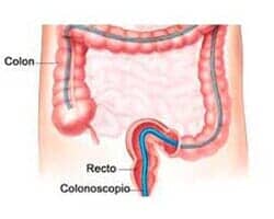 DR. GILBERTO RUIZ REYNA - cáncer de colon