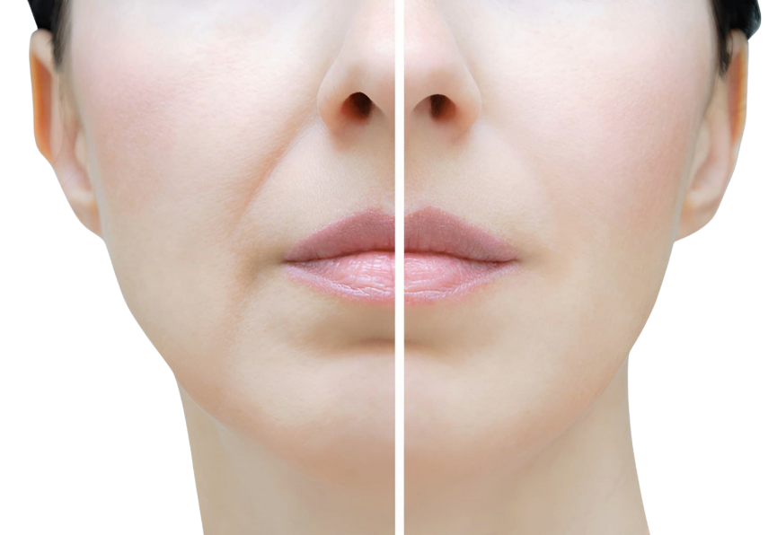 A before and after photo of a woman 's face with wrinkles. — Townsville Anti Aging in Currajong, QLD