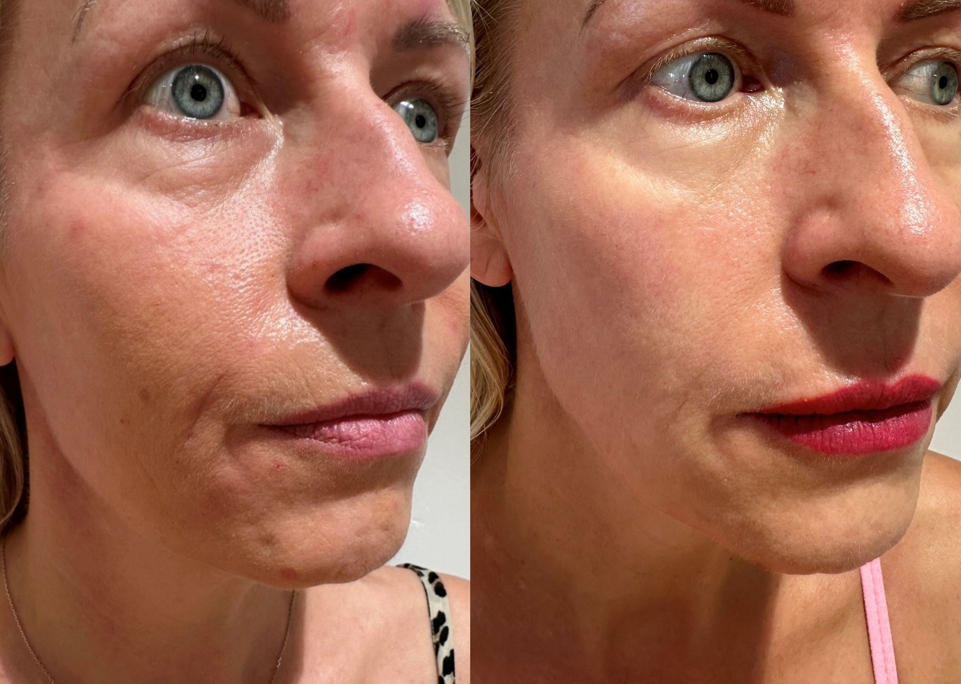 A Before and After Photo of a Woman's Face With Wrinkles — Townsville Anti Aging in Currajong, QLD