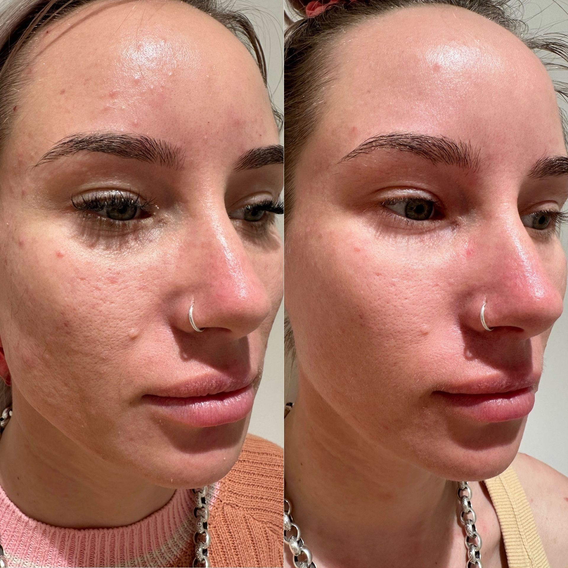 Before and after picture of girl with acne skin
