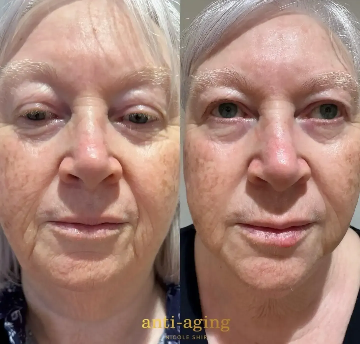 Side-by-side Comparison of Woman's Face — Townsville Anti Aging in Currajong, QLD
