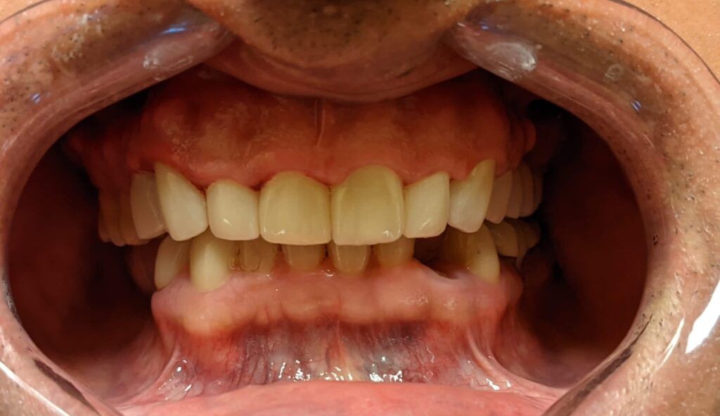 A close up of a person 's mouth with their teeth showing.