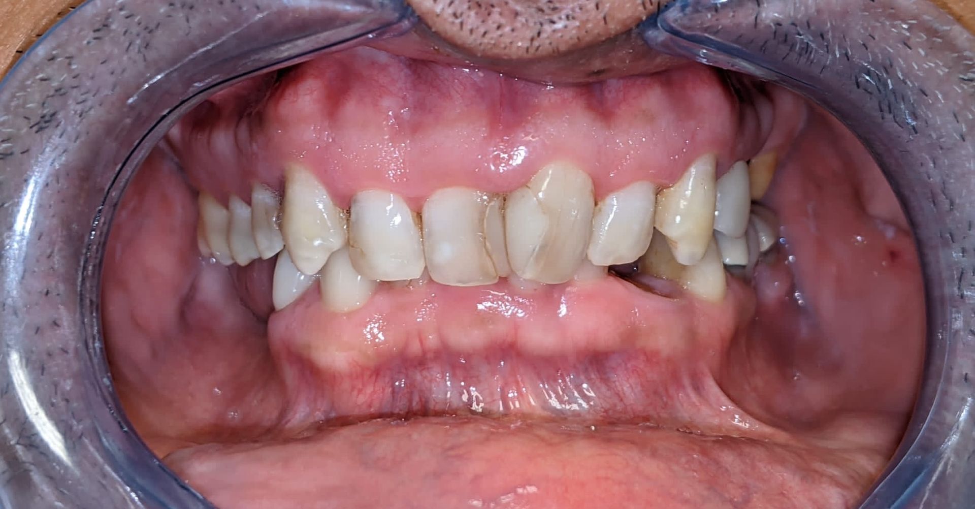 A close up of a person 's teeth with a mouth guard.