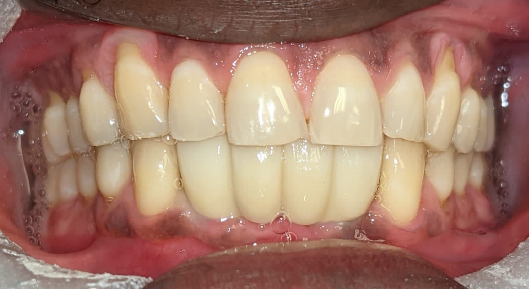 A close up of a person 's teeth with a dental bridge.