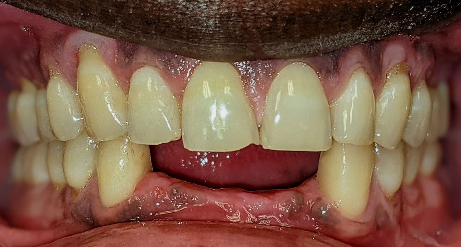 A close up of a person 's teeth with a missing tooth.