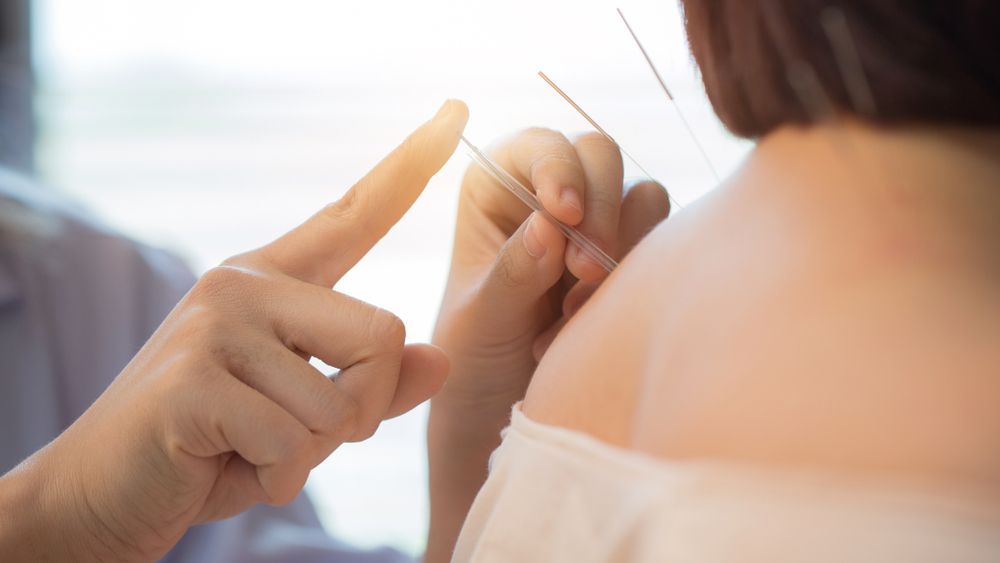 A Woman Is Getting Acupuncture On Her Back By A Doctor — HealthPoint Mingara In Tumbi Umbi, NSW