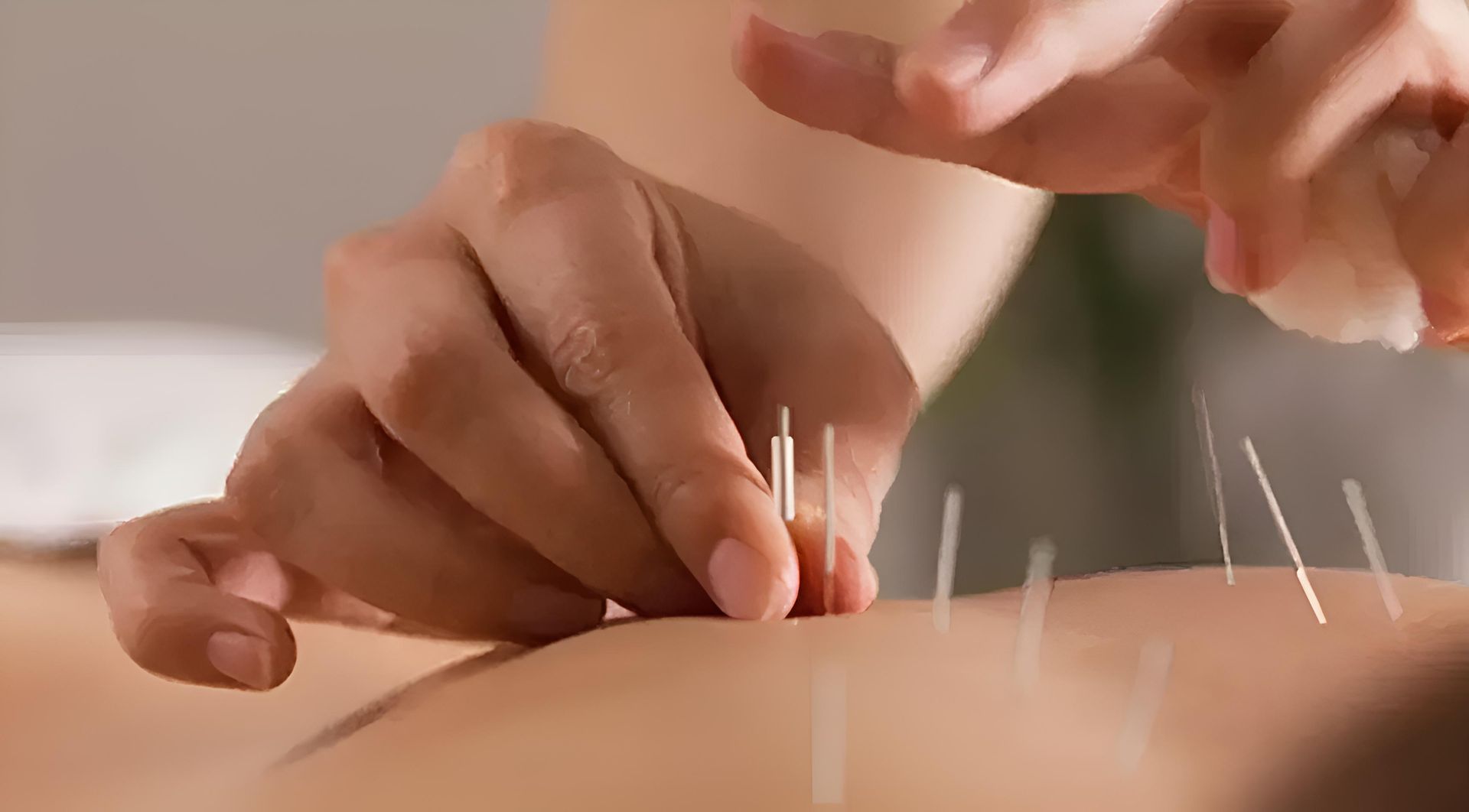 A person is getting acupuncture on their back. — HealthPoint Mingara In Tumbi Umbi, NSW