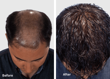 A before and after picture of a man 's hair