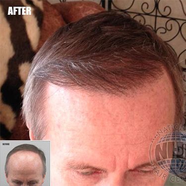 A close up of a man 's head with a before and after picture of his hair.