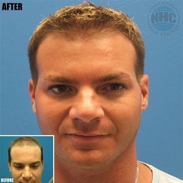 A before and after photo of a man 's face